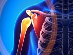 التهاب مفصل الكتف بسبب هشاشة العظام – وهو مرض مزمن في الجهاز العضلي الهيكلي