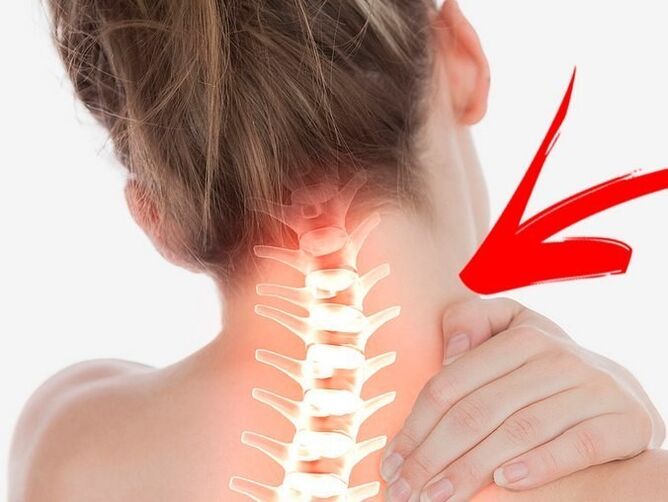 ضغط جذور الأعصاب مع هشاشة العظم العنقي