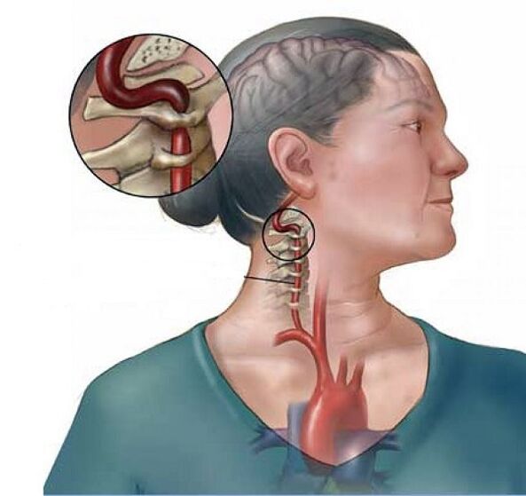 متلازمة الشريان الفقري مع داء عظمي غضروفي عنق الرحم