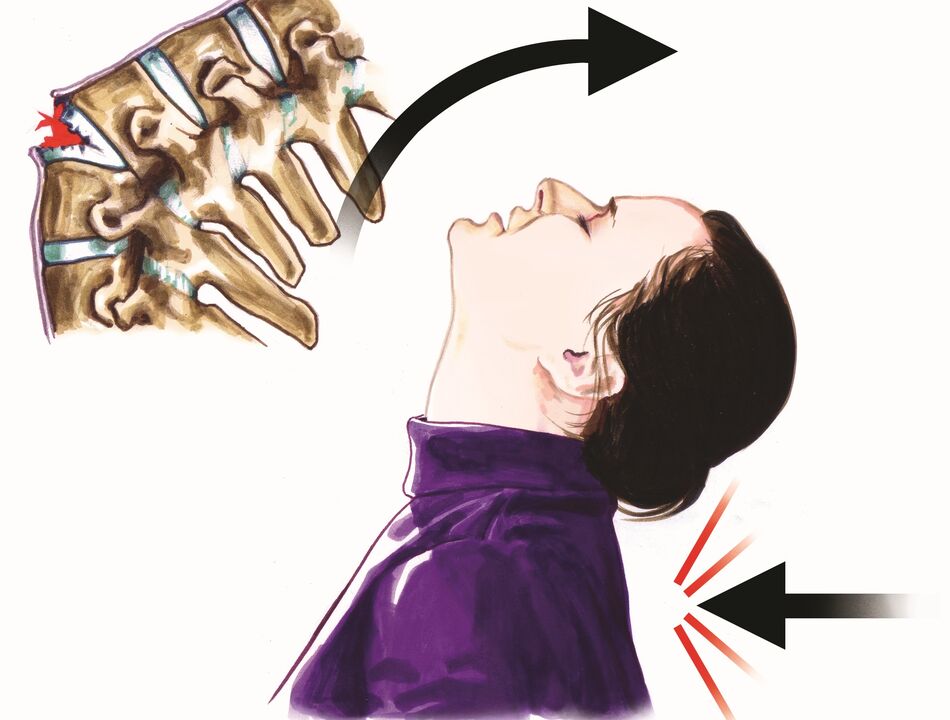 تلف العمود الفقري كسبب لآلام الرقبة